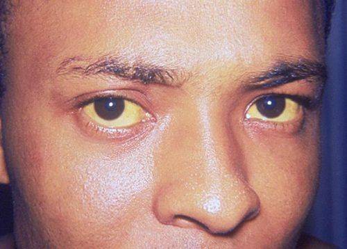 Желтая склера у глаз
