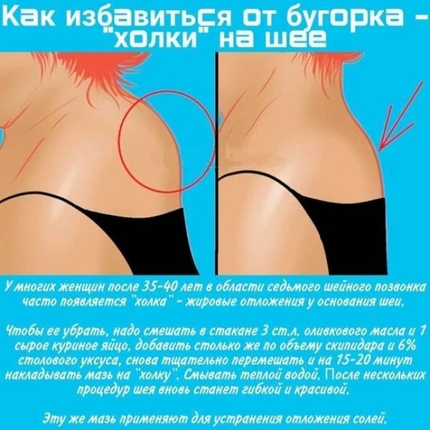 Как избавиться от валика на шее. как убрать холку на шее сзади — избавляемся от вдовьего горбика. почему появляется жировой валик на шее сзади - новая медицина