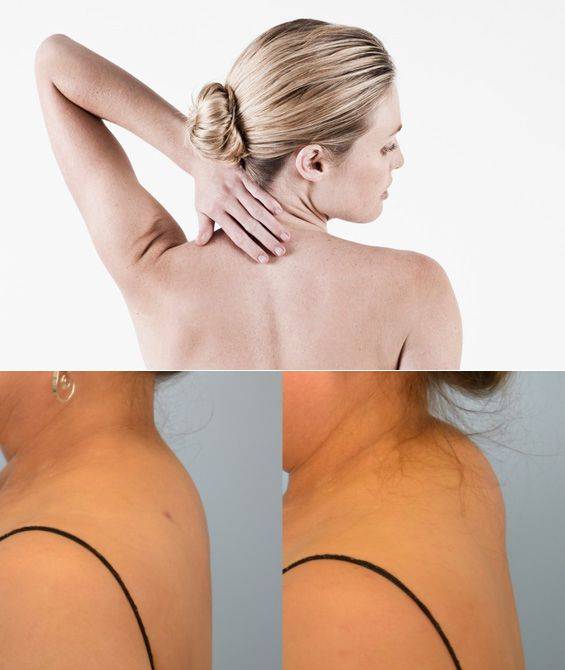 Как убрать холку на шее в домашних условиях упражнения