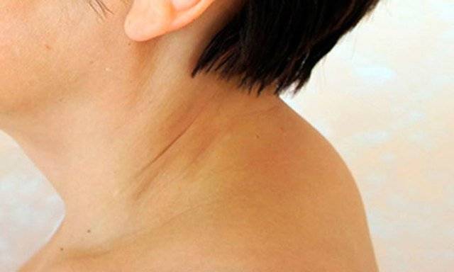 Как убрать холку на шее в домашних условиях упражнения