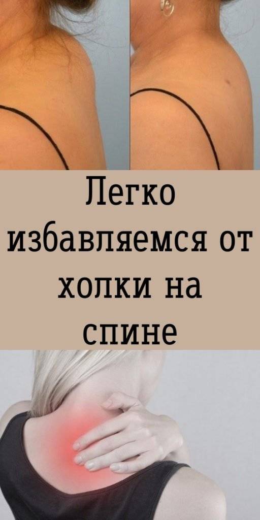 Как убрать холку на шее сзади — избавляемся от вдовьего горбика . милая я