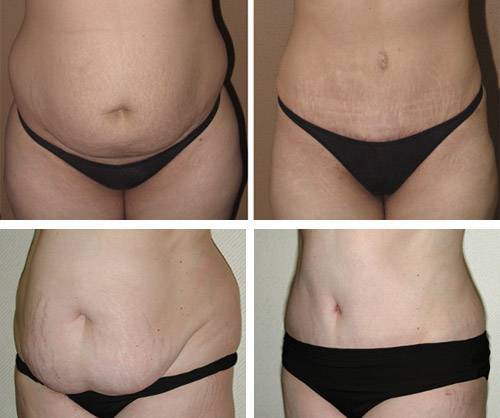 Как убрать обвисшую кожу после похудения массажем, кремами и косметическими процедурами