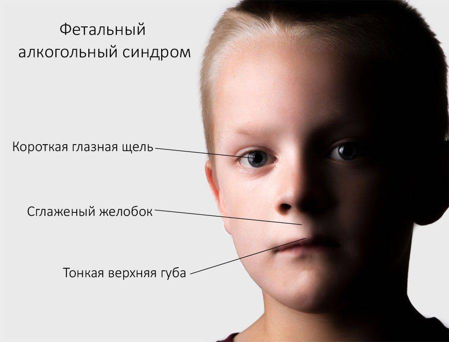 Синдром фас у детей фото