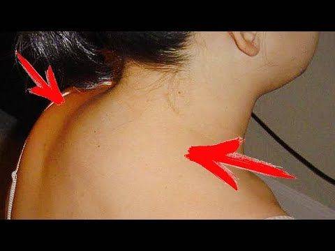 Как убрать холку на шее сзади в домашних условиях