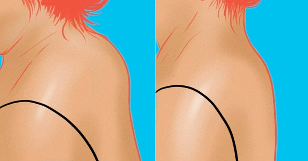 Как убрать холку на шее с помощью упражнений и массажа