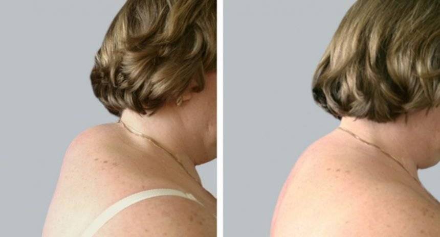 Как избавиться от холки на шее сзади у женщин в домашних условиях, массаж, упражнения