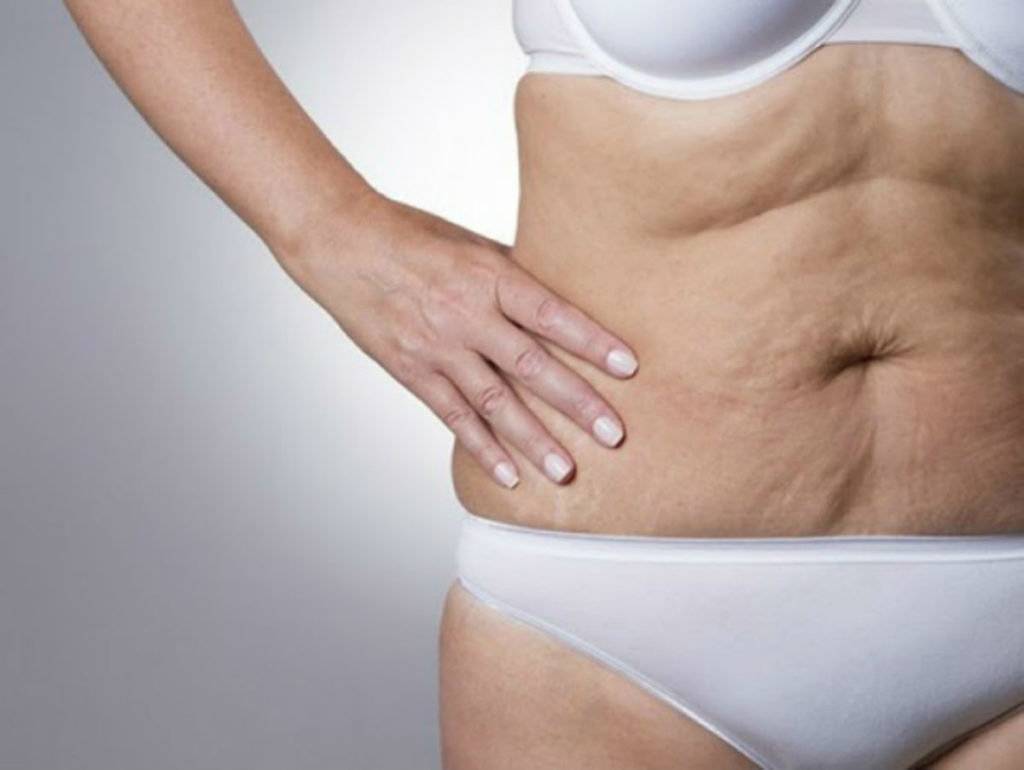 Как подтянуть кожу на животе быстро в домашних условиях? упражнения и обертывание