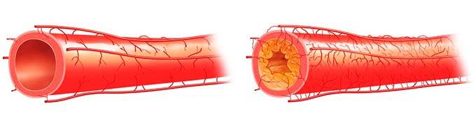 Расширение артериальных сосудов. Стеноз кровеносных сосудов. Суженные кровеносные сосуды. Сужение сосудов кожи и расширение. Сужает кровеносные сосуды.
