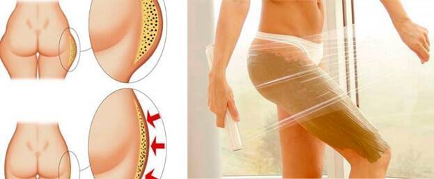 Как убрать целлюлит на ногах, ягодицах и бедрах в домашних условиях?