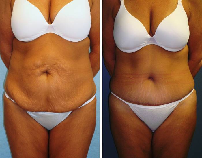 Как подтянуть обвисшую кожу на животе?