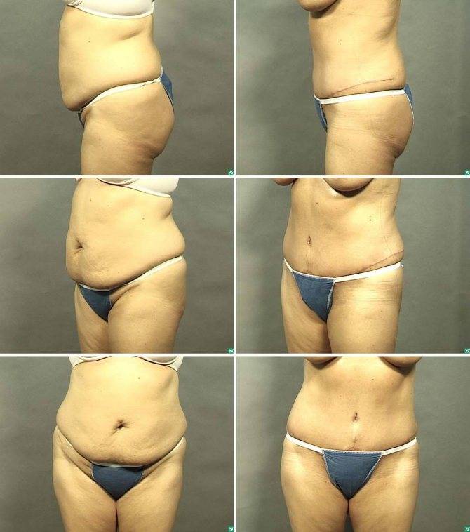 Как подтянуть кожу на животе после похудения: лучшие способы