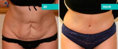 Как убрать лишнюю кожу с живота?