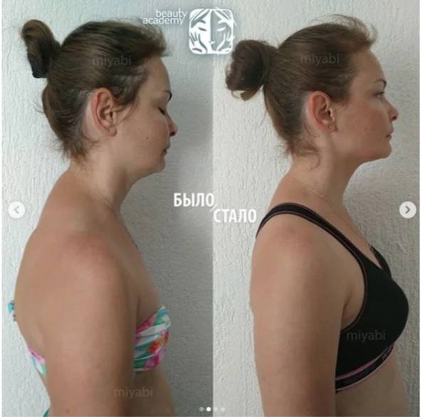 Как убрать холку на шее: методы массажа и упражнений