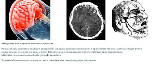 Какие последствия сотрясения. Сотрясение головного мозга. Сотрясени еголовоного мозга. Симптомы при сотрясении мозга у взрослых после удара. Сотрясение головного мозга снимок.