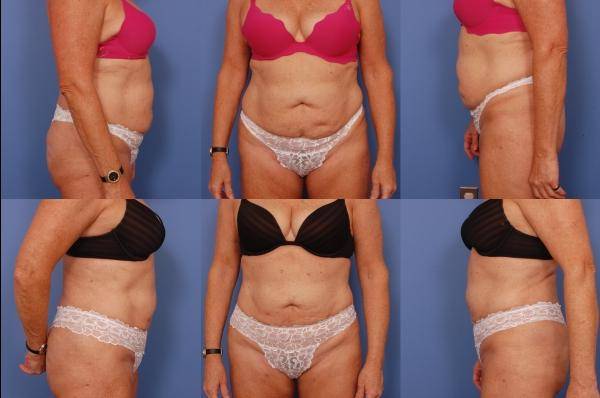 Как убрать обвисший живот в домашних условиях: питание и упражнения, чтобы избавиться от висячего животаwomfit