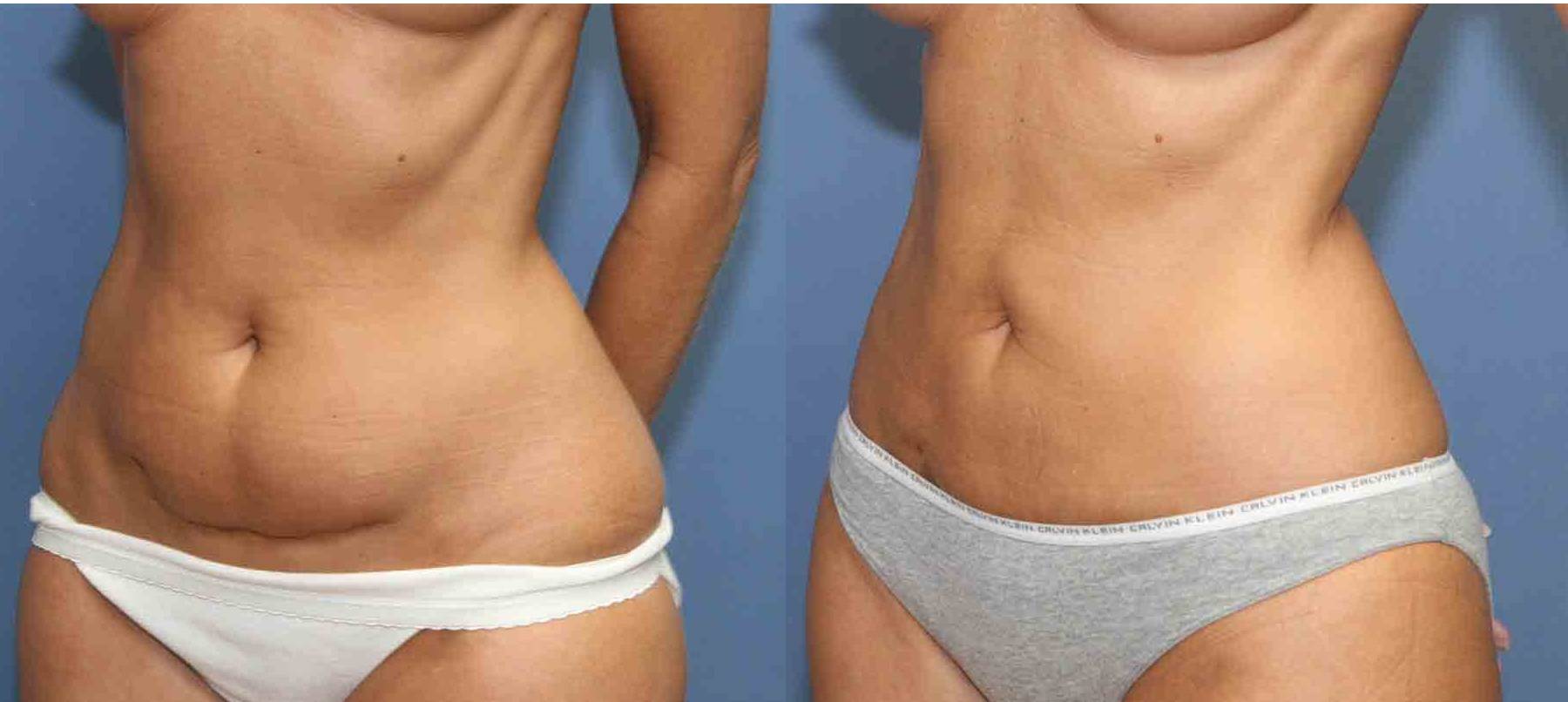 Дряблая кожа, растяжки и обвисший живот: какие меры помогут