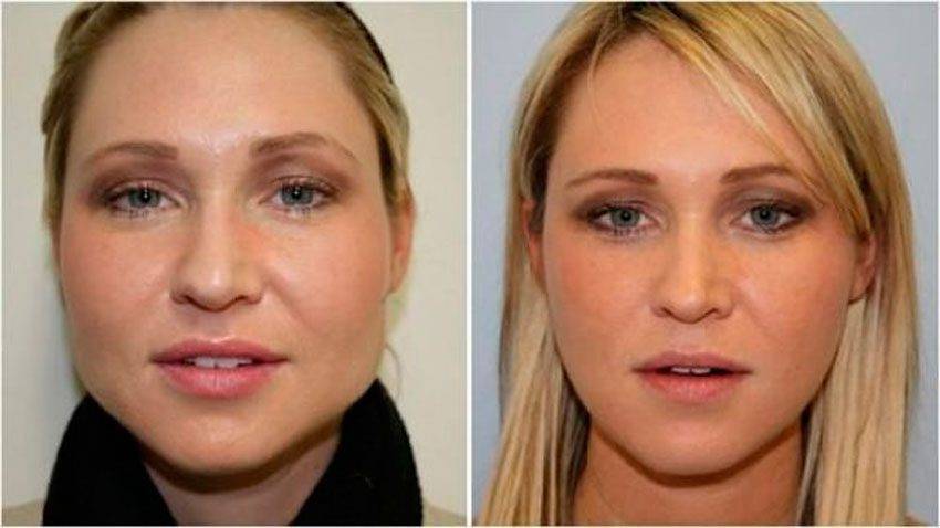 Как похудеть в лице, чтобы появились скулы и впали щеки