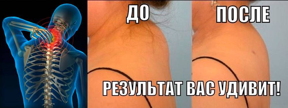 Почему появляется холка на шее, как избавиться от нее