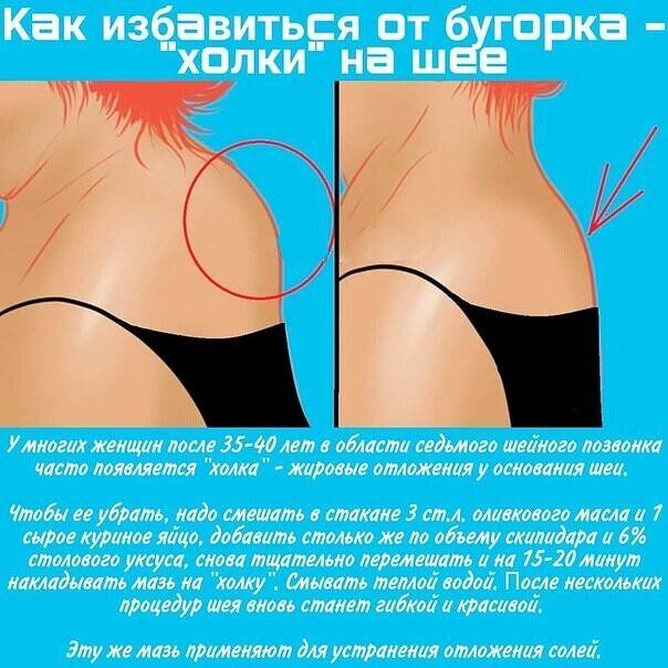 Как избавиться от холки на шее сзади
