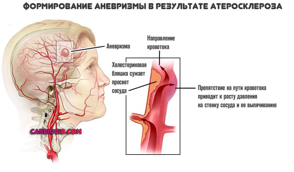 Аневризма сонной артерии что это. Операция аневризмы сонной артерии головы. Аневризма внутренней сонной артерии головного. Аневризма внутренней сонной артерии классификация. Мешковидная аневризма сонной артерии.