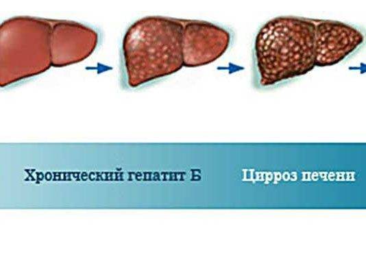 Диета при жировом гепатозе печени