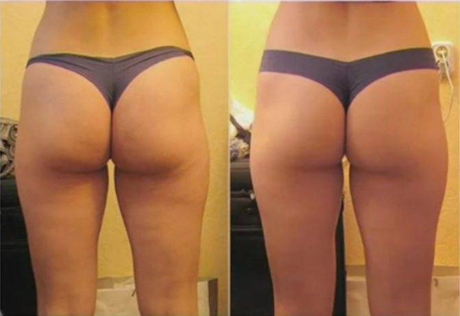 Упражнения от целлюлита на ногах и попе: 2 эффективных комплекса