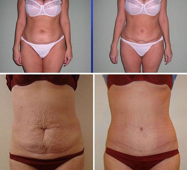 Как подтянуть кожу на животе после похудения и убрать дряблость в домашних условиях и салоне