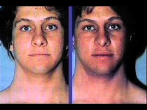 Меланотан 2 инструкция по применению противопоказания