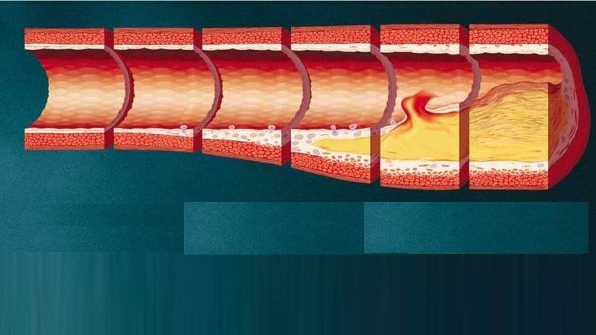 Тромб и бляшка разница. Атеросклерозная бляшка сосуда. Стенозирующий атеросклероз маг. Атеросклеротическая бляшка в сонной артерии. Холестериновая бляшка в сонной артерии.