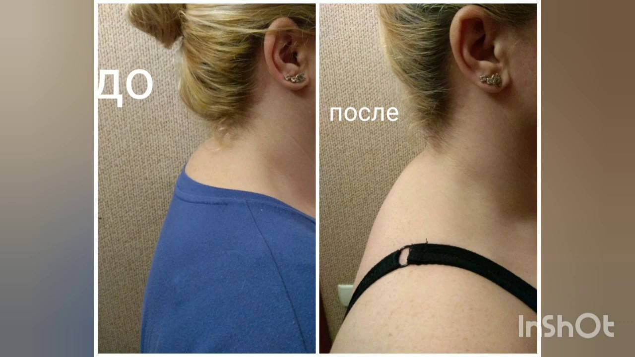 Как избавиться от холки на шее? » женский мир