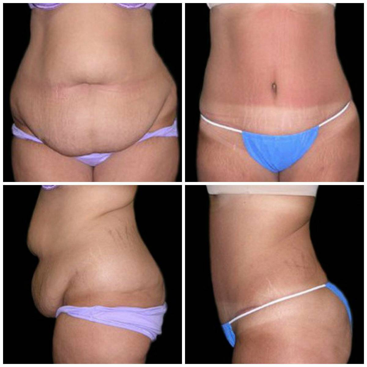 Как бороться с обвисшей кожей и привести тело в порядок