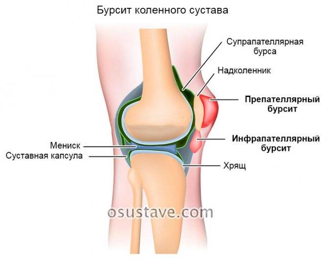 Хруст в коленях при сгибании