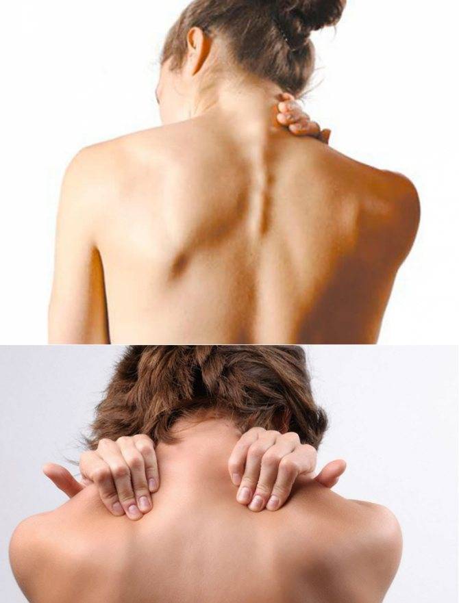 Как убрать холку на шее сзади в домашних условиях