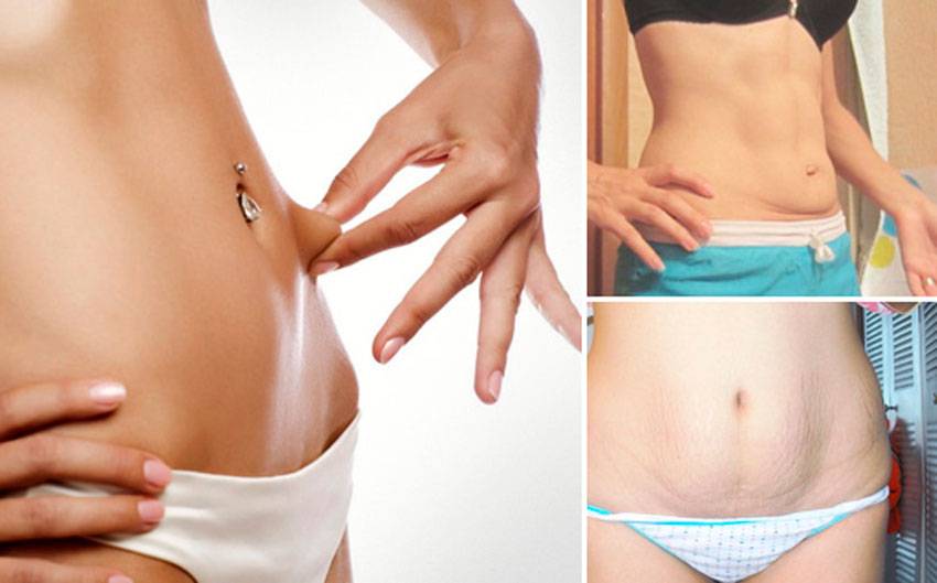 Как убрать дряблость кожи на животе после похудения в домашних условиях